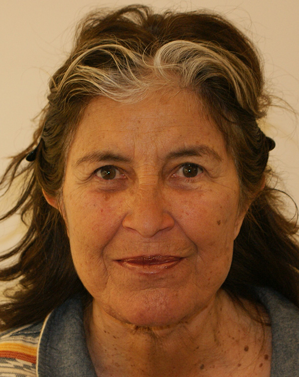 Face and Neck Lift before and after - after