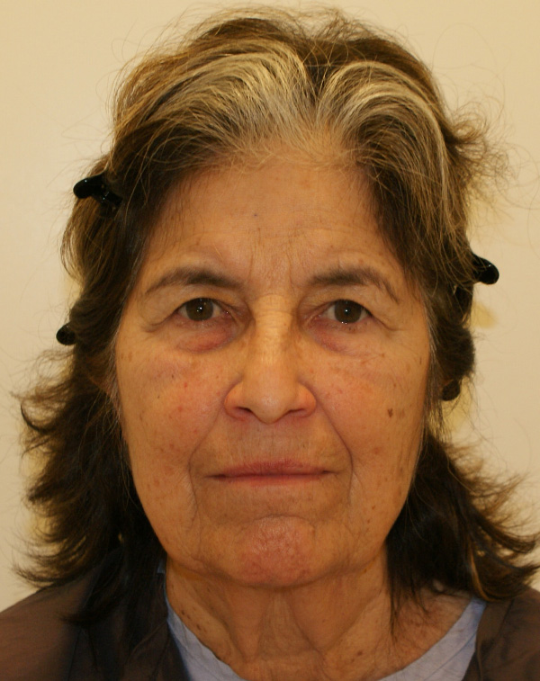 Face and Neck Lift before and after - before