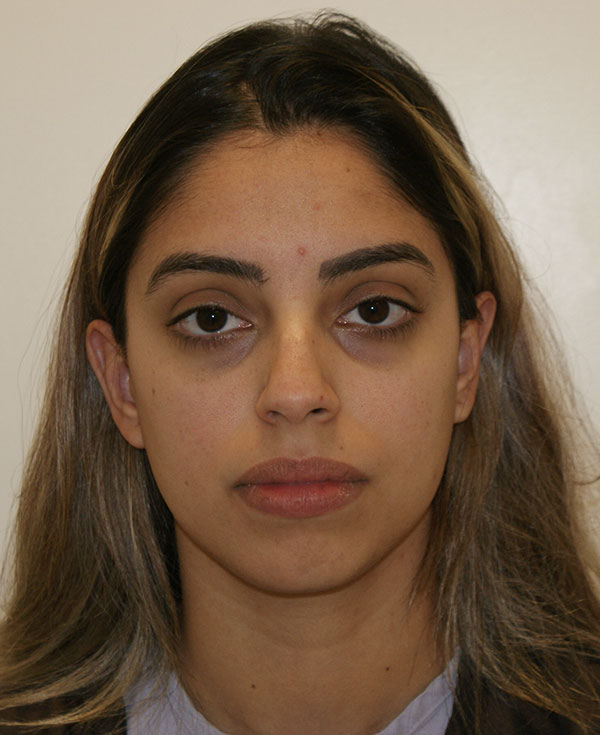 Rhinoplasty before and after - before