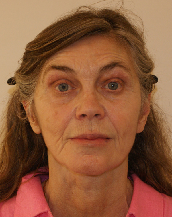 Face and Neck Lift before and after - after