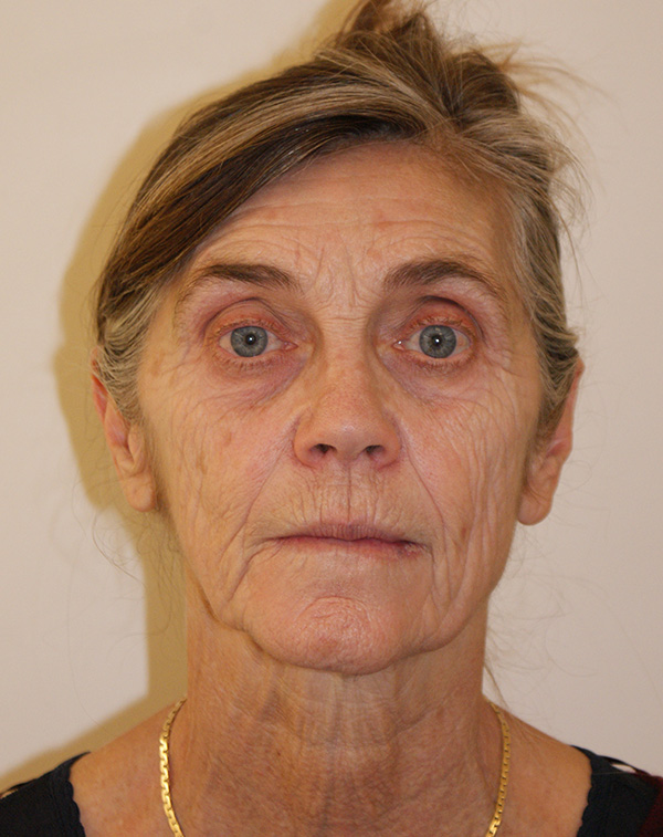 Face and Neck Lift before and after - before