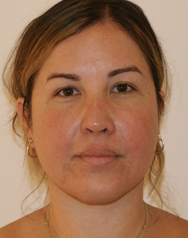 Short Scar Neck Lift before and after - after