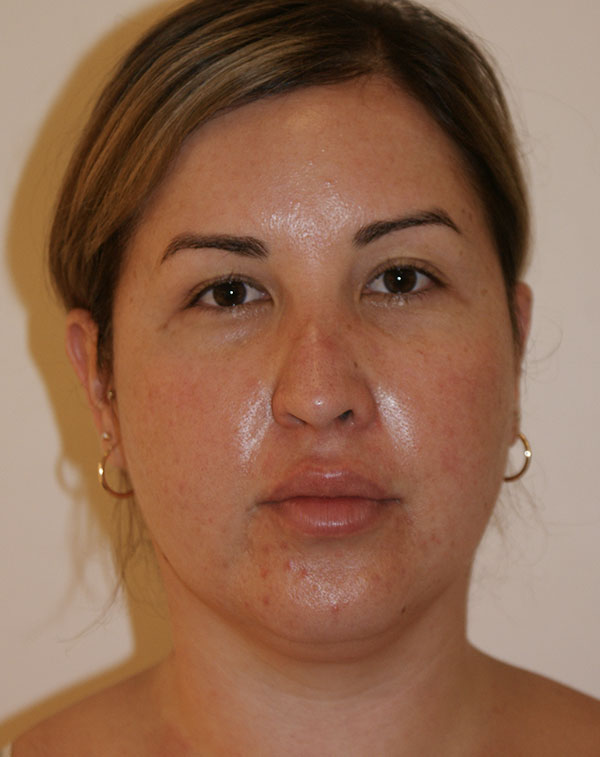Short Scar Neck Lift before and after - before