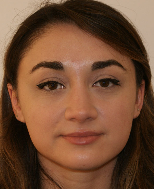 Rhinoplasty before and after - after