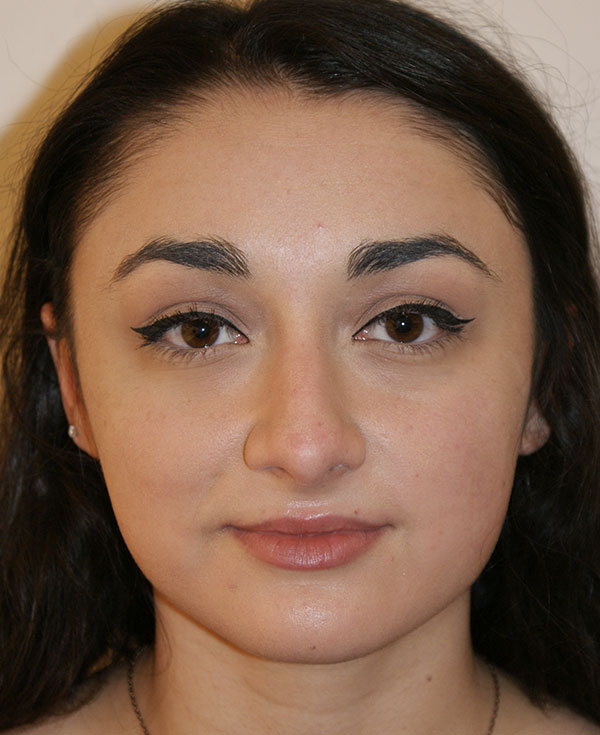 Rhinoplasty before and after - before