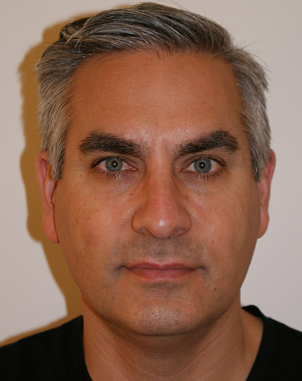 Face and Neck Lift before and after - before