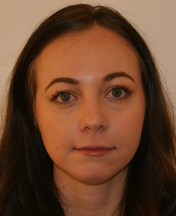 Rhinoplasty before and after - after