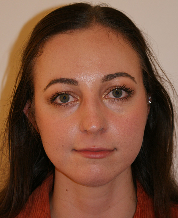 Rhinoplasty before and after - before