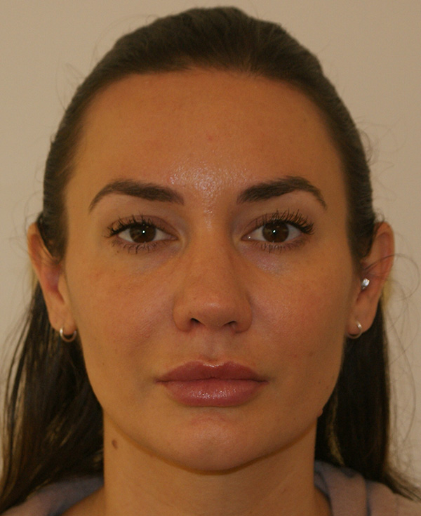 Rhinoplasty before and after - after