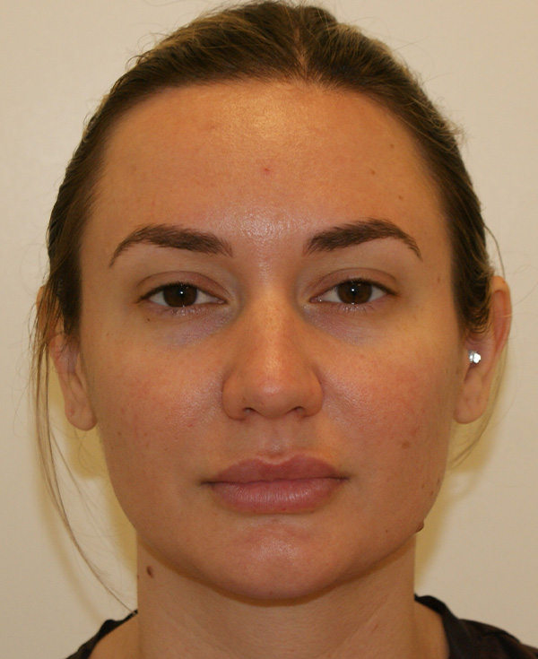Rhinoplasty before and after - before