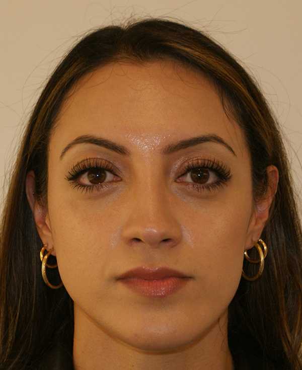 Rhinoplasty before and after - after
