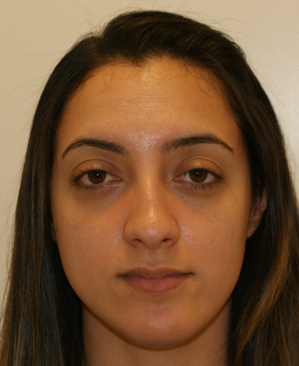 Rhinoplasty before and after - before