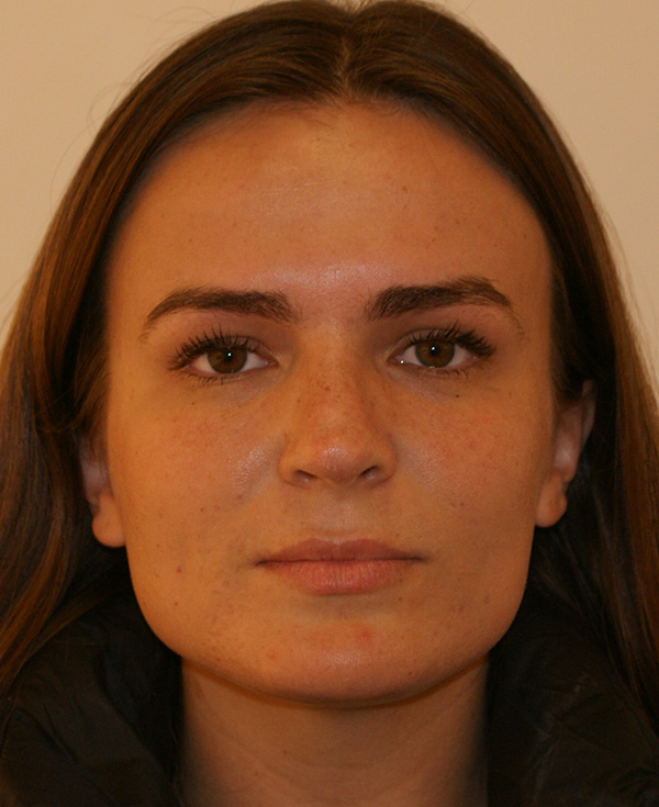 Rhinoplasty before and after - after
