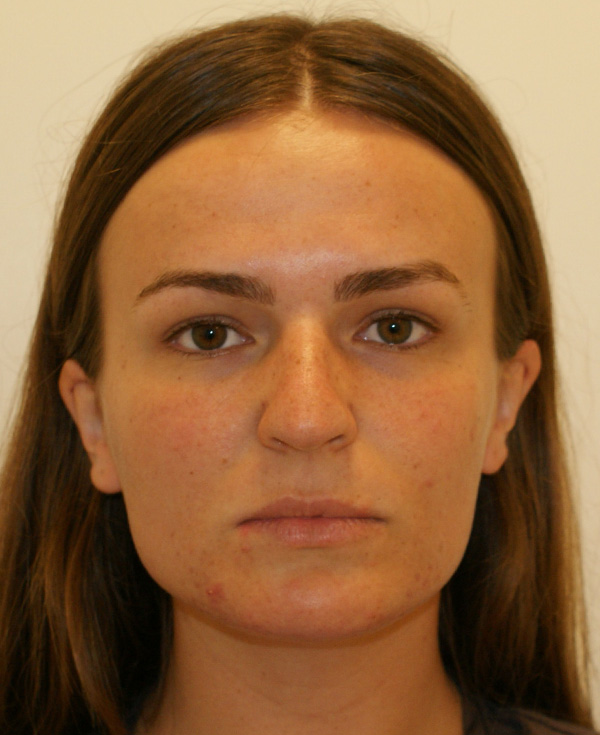 Rhinoplasty before and after - before