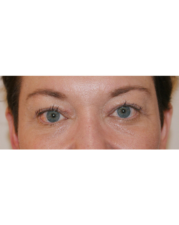 Facial Fat Transfer before and after - after
