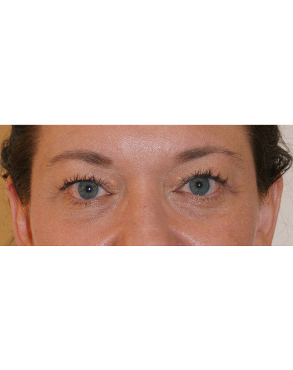 Facial Fat Transfer before and after - before