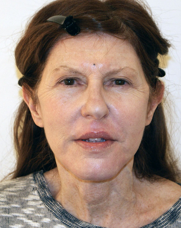 Face and Neck Lift before and after - after