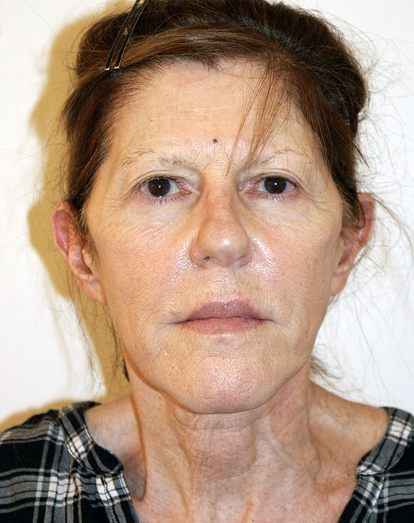 Face and Neck Lift before and after - before