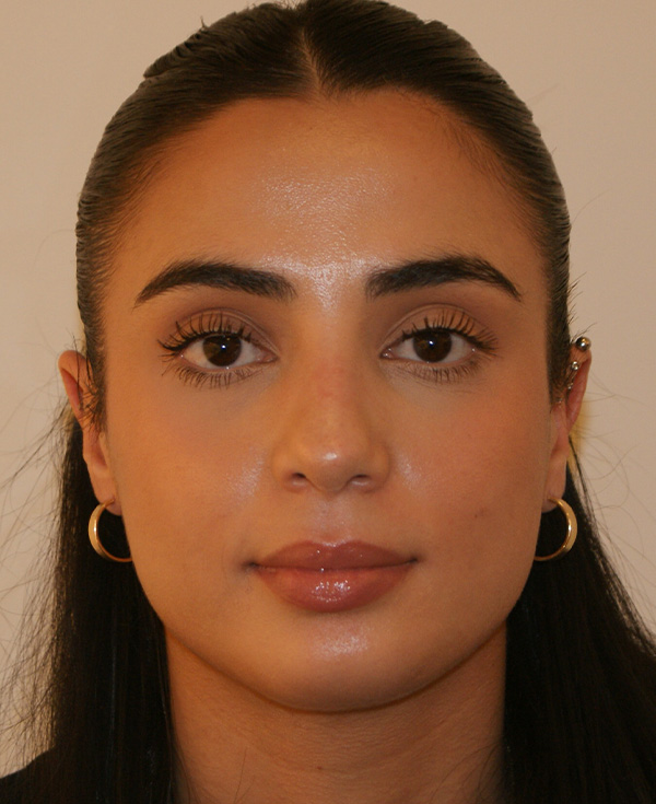 Rhinoplasty before and after - after