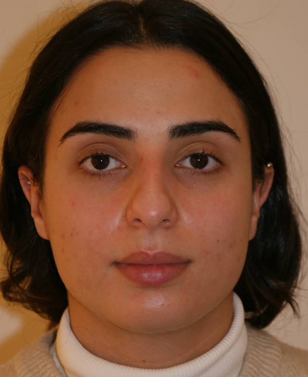 Rhinoplasty before and after - before