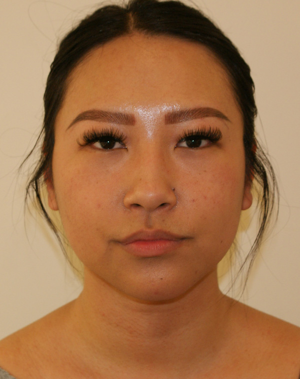 Face and Neck Lift before and after - after