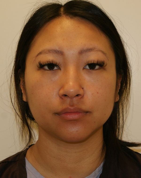 Face and Neck Lift before and after - before