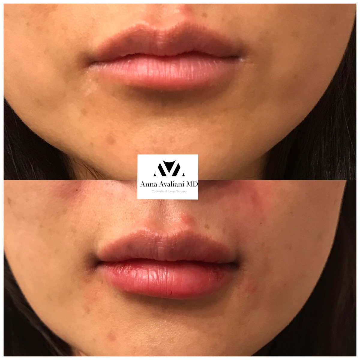 Lip Augmentation after — Dr. Anna Avaliani
