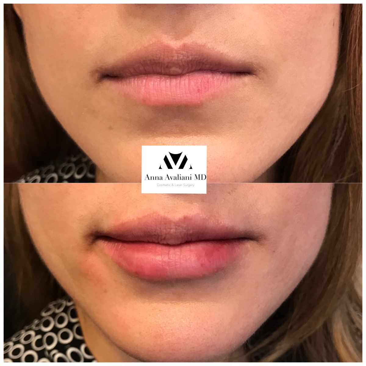 Lip Augmentation before — Dr. Anna Avaliani