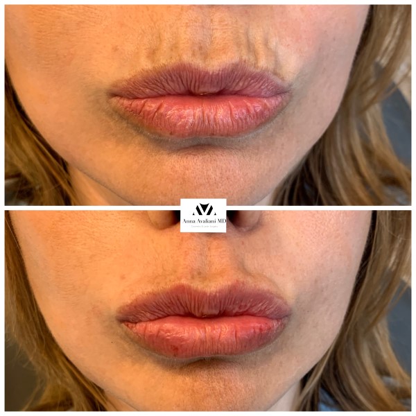 Lip Augmentation after — Dr. Anna Avaliani