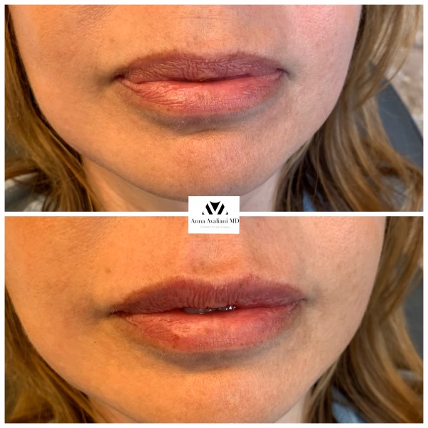 Lip Augmentation before — Dr. Anna Avaliani
