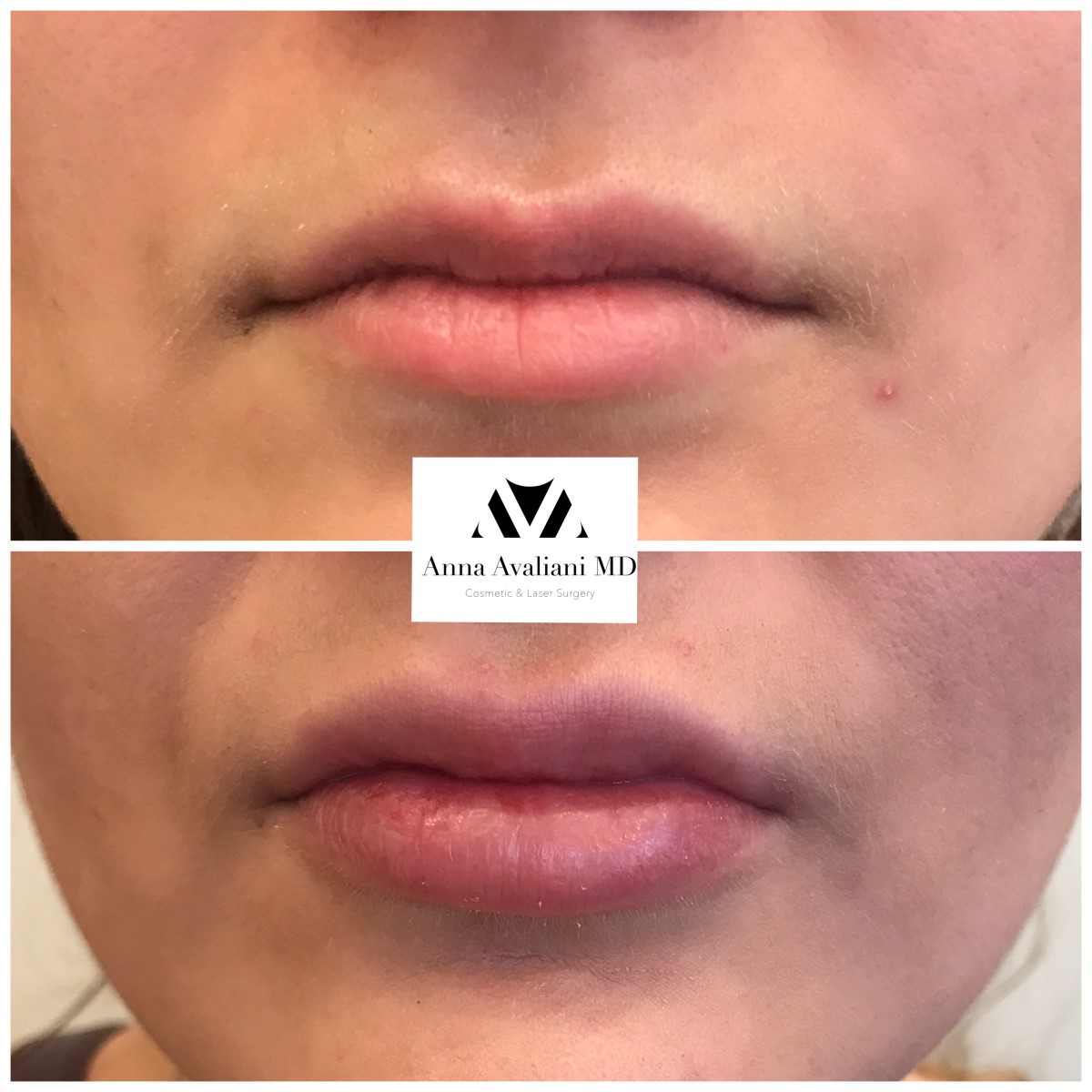 Lip Augmentation after — Dr. Anna Avaliani