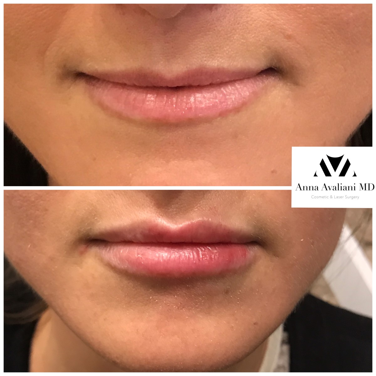Lip Augmentation before — Dr. Anna Avaliani