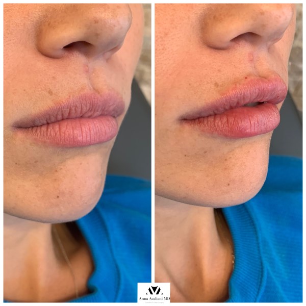 Lip Augmentation after — Dr. Anna Avaliani