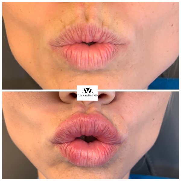 Lip Augmentation before — Dr. Anna Avaliani