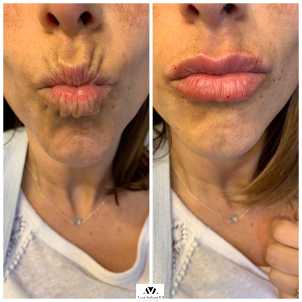 Lip Augmentation after — Dr. Anna Avaliani