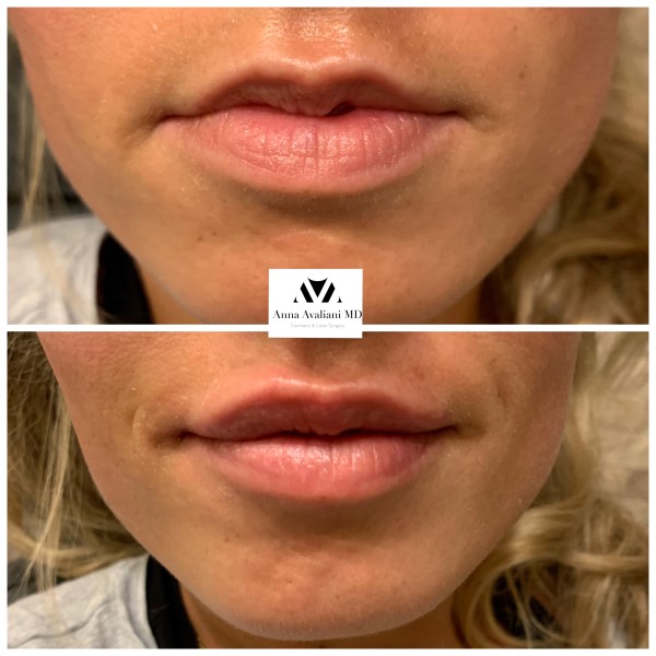 Lip Augmentation before — Dr. Anna Avaliani