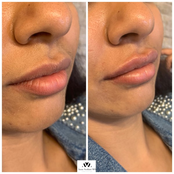 Lip Augmentation after — Dr. Anna Avaliani