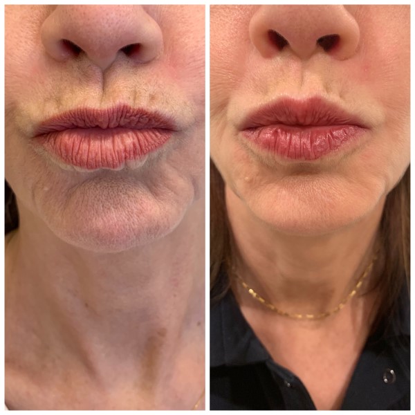 Lip Augmentation before — Dr. Anna Avaliani