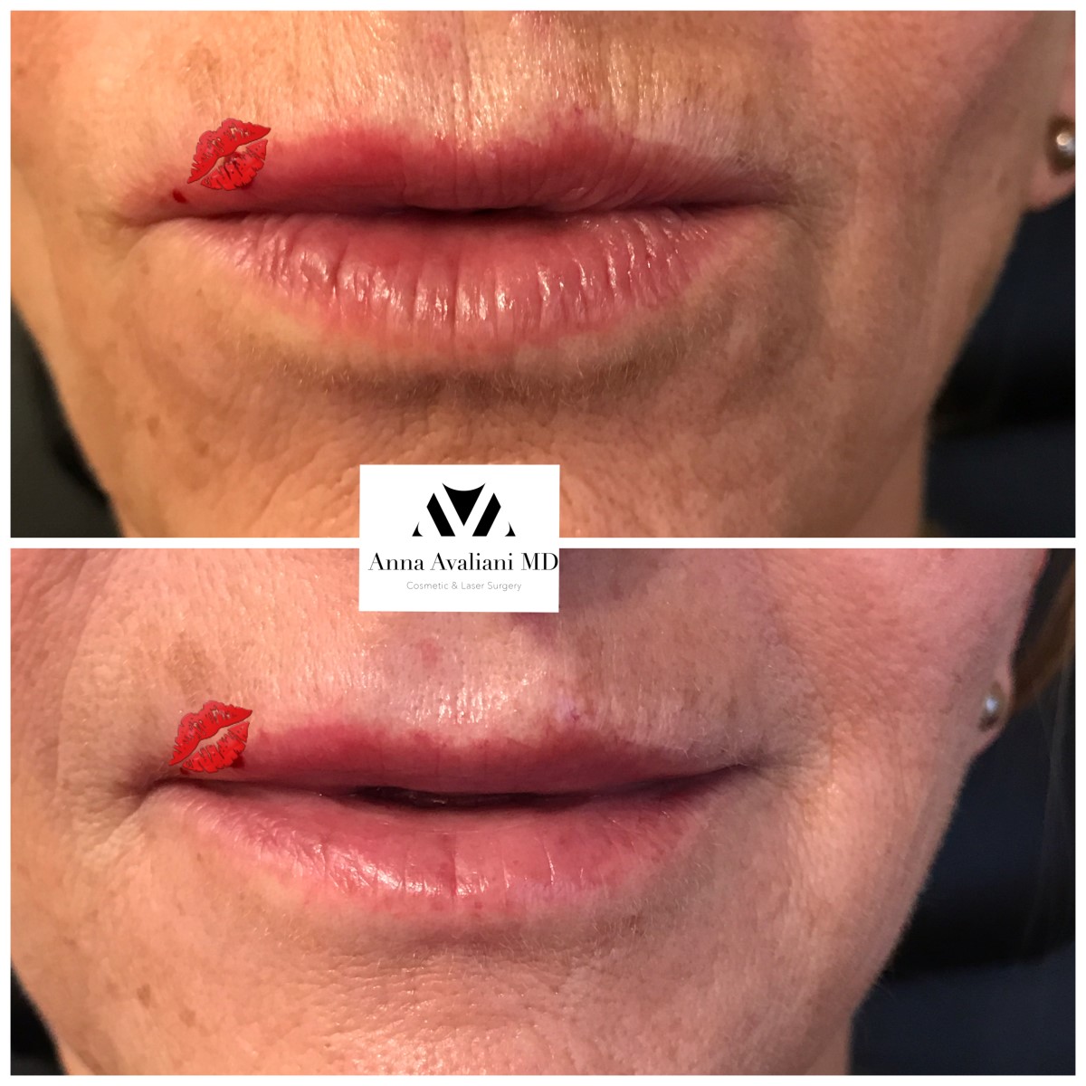 Lip Augmentation after — Dr. Anna Avaliani