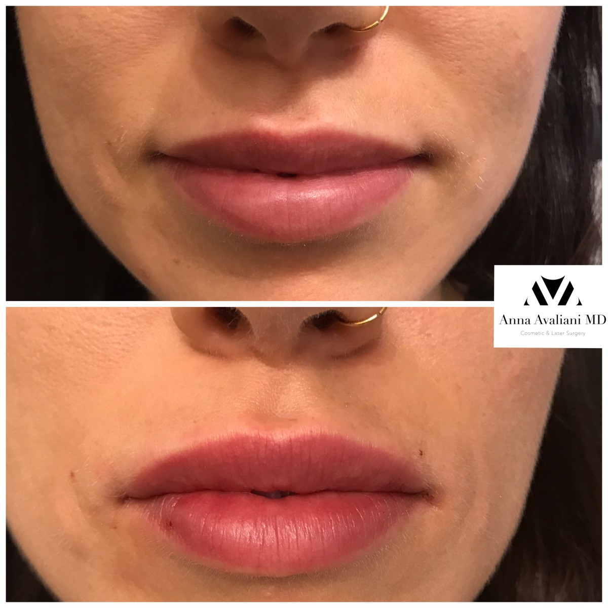 Lip Augmentation before — Dr. Anna Avaliani