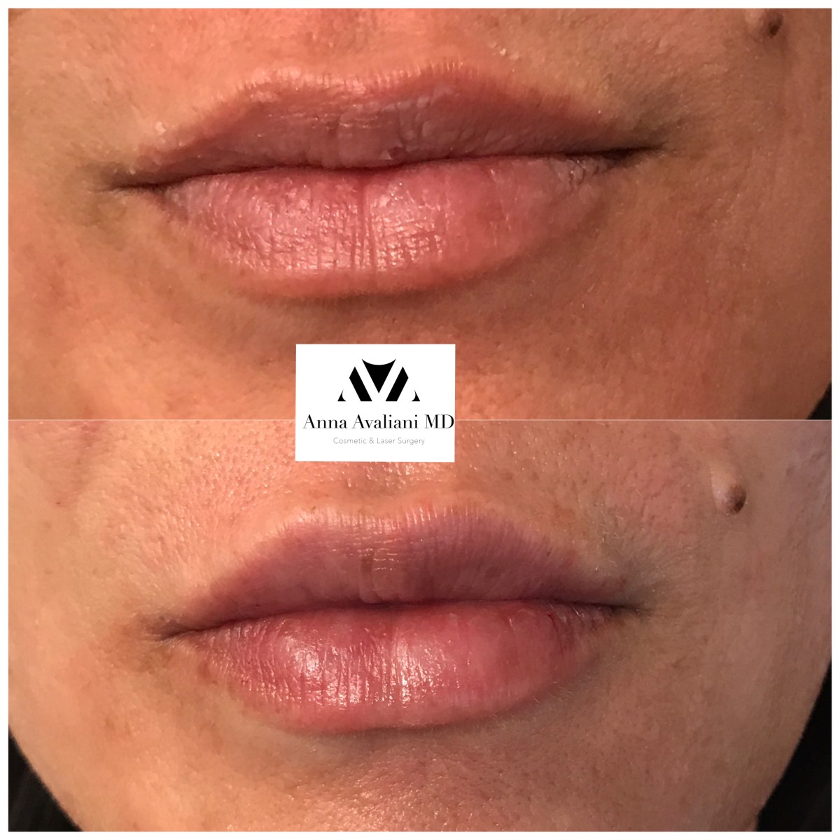 Lip Augmentation after — Dr. Anna Avaliani