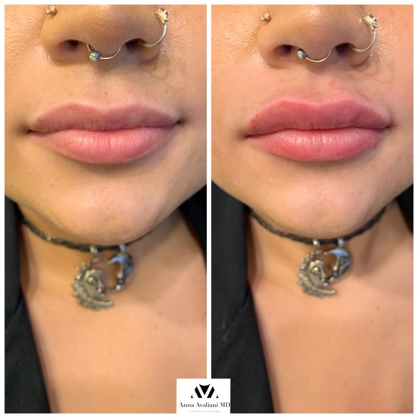 Lip Augmentation before — Dr. Anna Avaliani