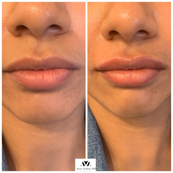 Lip Augmentation after — Dr. Anna Avaliani