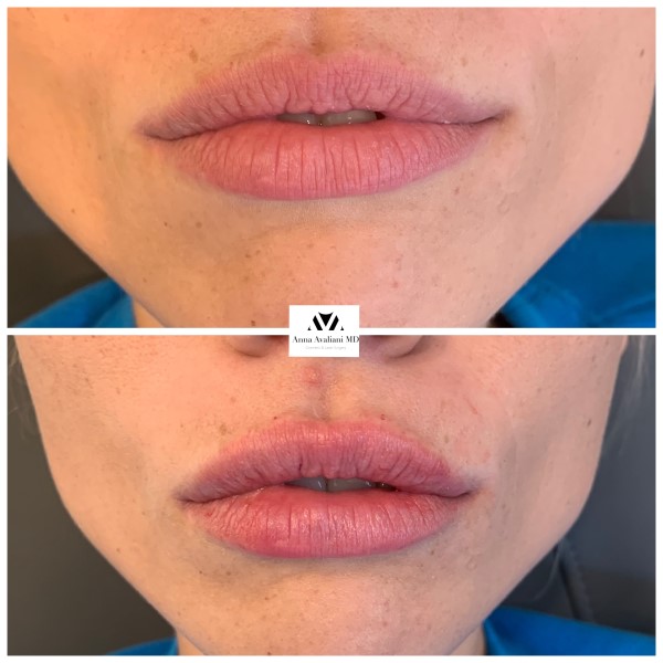 Lip Augmentation before — Dr. Anna Avaliani