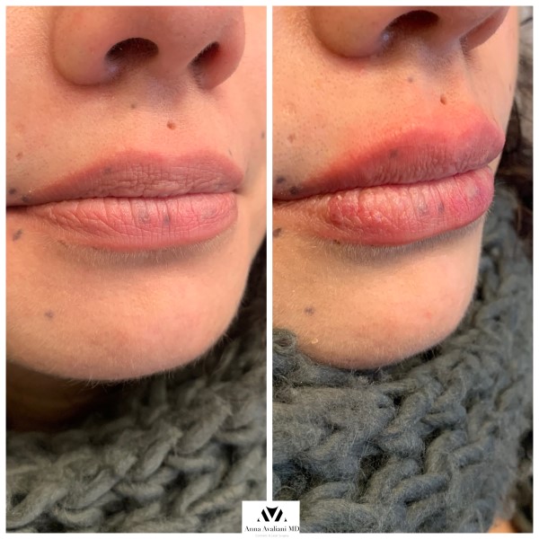 Lip Augmentation after — Dr. Anna Avaliani