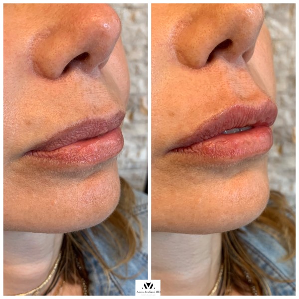 Lip Augmentation before — Dr. Anna Avaliani