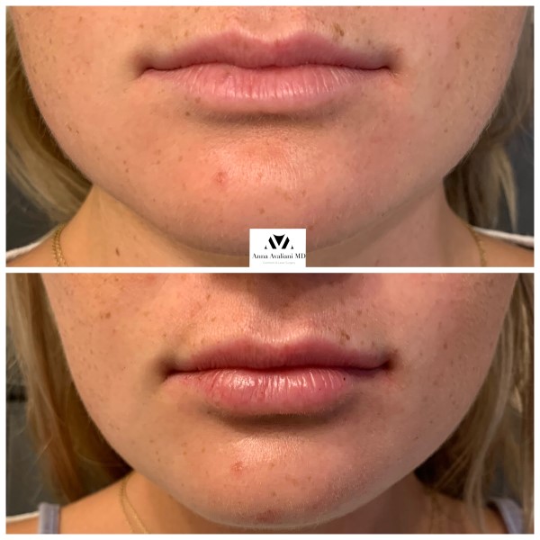 Lip Augmentation after — Dr. Anna Avaliani