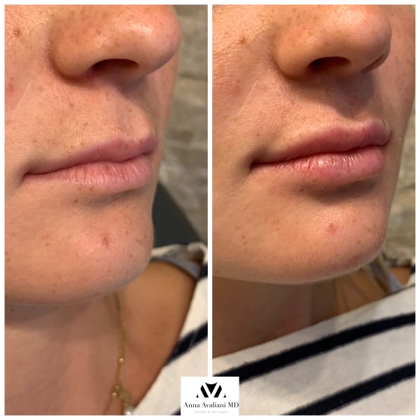Lip Augmentation before — Dr. Anna Avaliani