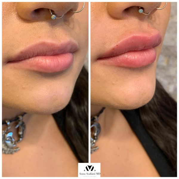 Lip Augmentation after — Dr. Anna Avaliani