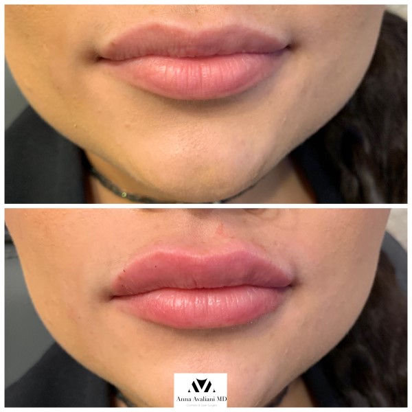 Lip Augmentation before — Dr. Anna Avaliani
